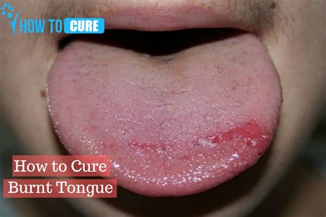 How To Cure Burnt Tongue Tips To Cure Burning Tongue How To Cure