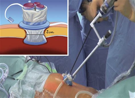 Single Access Laparoscopic Sigmoidectomy As Definitive Surgical Management Of Prior