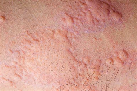 7 Common Types Of Skin Rashes In The Philippines
