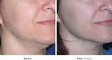 Ultherapy Side Effects Swelling Pictures