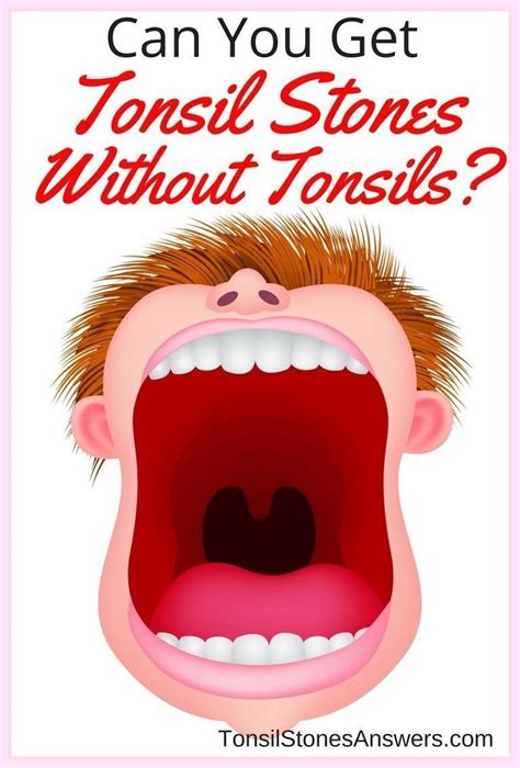 How To Get Rid Of Tonsil Stones How To Remove Tonsil Stones How To Get