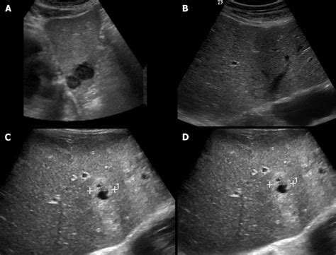 Ultrasound Images Showing Variable Echogenicity Of Liver Metastases A