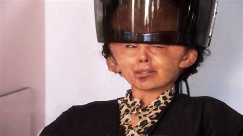 Woman Dyed A Head The Head Swelled Into Three Times The Size Of The