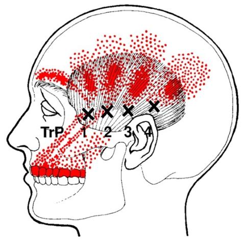 Temporalis Trigger Points And Referred Pain Patterns