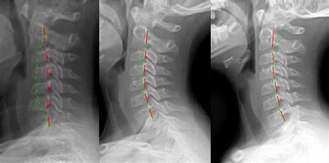 Pdf Improving The Cervical Lordosis Relieves Neck Pain And Chronic