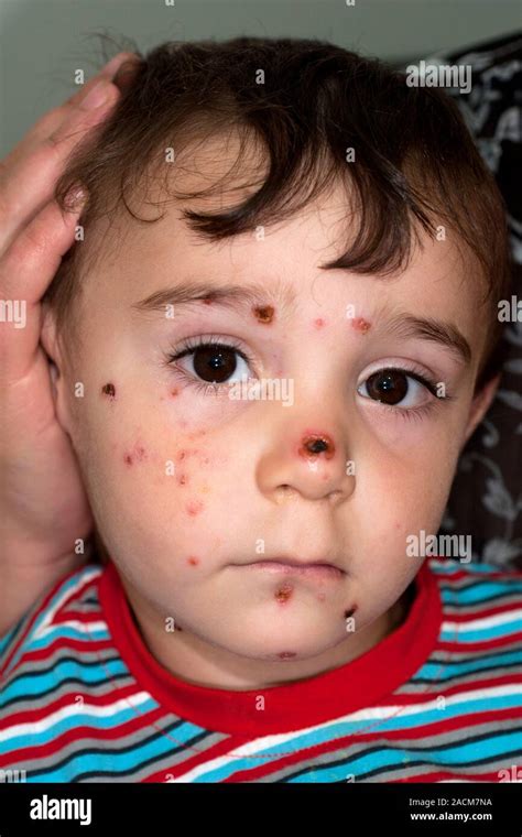Scabbed Pústulas Llagas En La Cara De Un Niño De 3 Años De Edad