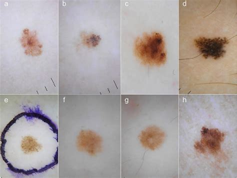 Melanoma Photos Early Stage Symptoms And Pictures