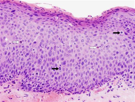 Severe Squamous Dysplasia Or Carcinoma In Situ Causing Laryngeal