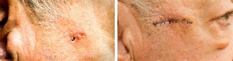 Basal Cell Carcinoma On The Face Containing Basal Cell And Carcinoma