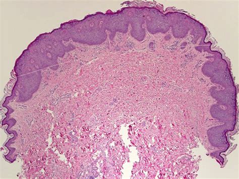 Acquired Epidermodysplasia Verruciformis Secondary To Methotrexate