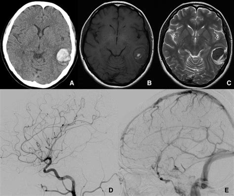 A Ct Shows Hematoma In The Left Temporal Lobe B C Mr Images Show