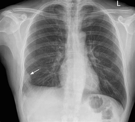 Do X Rays Show Pulmonary Embolism Kwhatdo