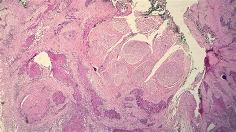 Squamous Cell Carcinoma Keratinizing Type Moderately Differentiated