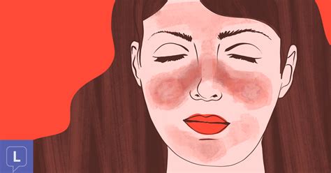 What Is A Lupus Butterfly Rash And How Do I Deal With It