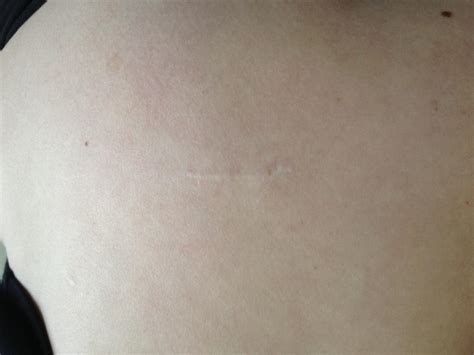 Before And After Sleeve Scars Gastric Sleeve Surgery Forums