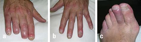 Buerger's disease (thromboangiitis obliterans): clinical features and
