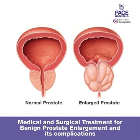 Enlarged Prostate Treatment
