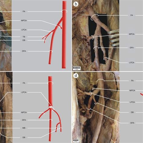 Type 2 Medial And Lateral Femoral Circumflex Artery Variation