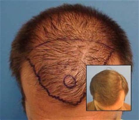 Behnam's hand crafted punches deliver the best results. Hair Transplant Los Angeles |Dr Sean Behnam MD