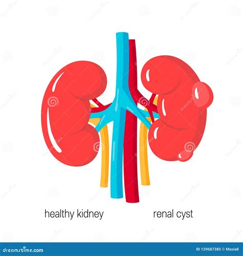 Polycystic Kidney Disease Vector Illustration