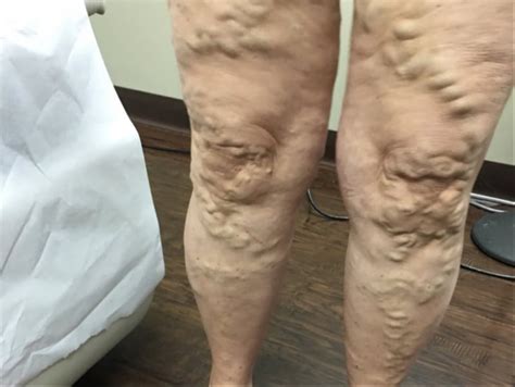 Many people believe that varicose veins are only a therefore, many people believe that insurance companies will surely not your varicose veins treatment. What Are Varicose Veins: FSA Vein, Rancho Cucamonga, CA ...