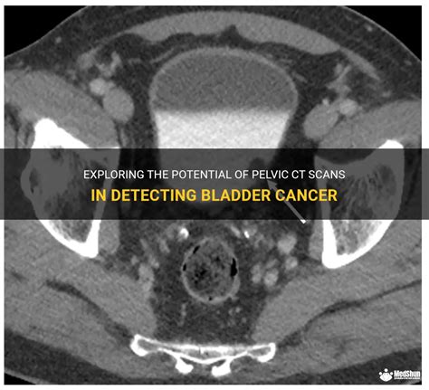 Exploring The Potential Of Pelvic Ct Scans In Detecting Bladder Cancer
