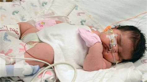 See What Extremely Rare Nearly Pound Newborn Looks Like Abc News