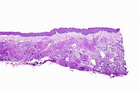 Eosinophilic Granuloma Histology