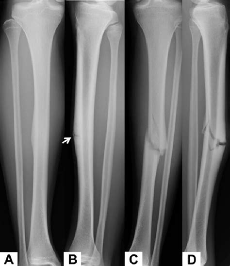 Figure 4 From Recurrent Fracture After Anterior Tension Band Plating