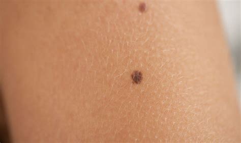 The diagnosis of melanoma involves the visually recognition of this characteristic tumor first. Skin cancer symptom: Melanoma sign could be dark stripe on ...