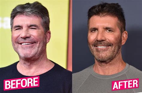 Simon Cowell Before And After Plastic Surgery What Happened To His Face