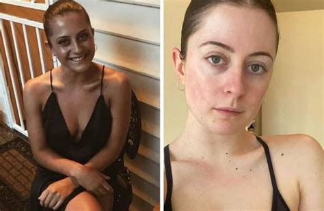 Woman Reveals Awful Addiction To Fake Tan After Being Bullied Nz Herald
