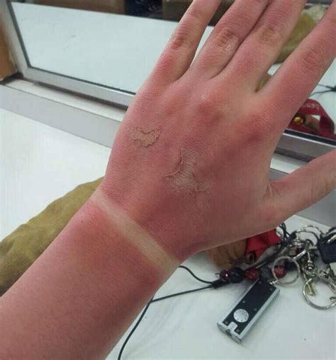 Briefly touching a hot pot, for example, would give you a first first degree burns are the least severe kind of burns. 8 best images about first degree burns on Pinterest | The ...