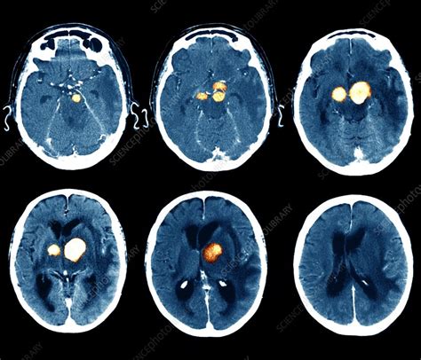 Brain Cancer Ct Scans Stock Image M1340465 Science Photo Library