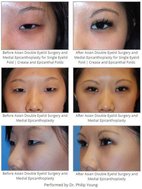 Before And After Asian Double Eyelid Surgery And Medial Epicanthoplasty