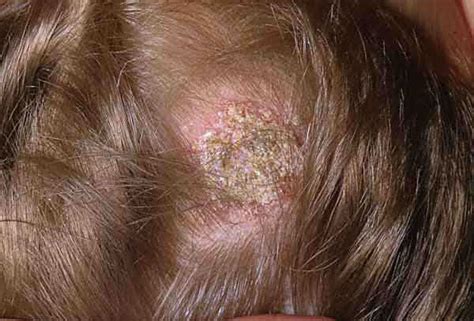 Tinea Capitis Symptoms Pictures Causes Treatment Prevention