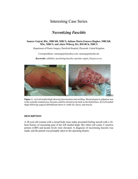 Necrotizing Soft Tissue Infection Pictures