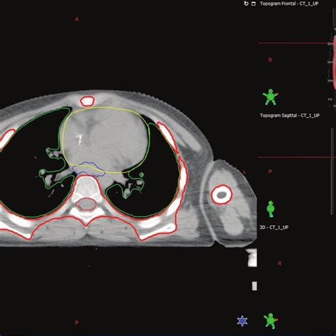 Dose Distribution Maps Of Patient 3 Treated With Tbi The Radiotherapy