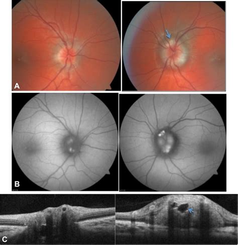 The Swollen Optic Nerve An Approach To Diagnosis And Management