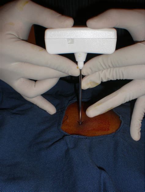 Figure From Bone Marrow Biopsy Needle Vs Bone Biopsy Needle In Ct