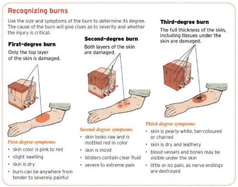How To Treat A Burn Ent Wellbeing Sydney Burns Nursing Burn Injury