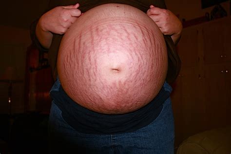 Stretch Marks How You Get Them And How To Get Rid Of Them Science Times