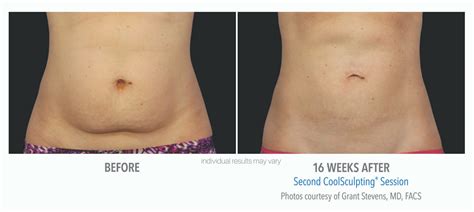 Coolsculpting Before And After Real Patient Photos Vein Laser