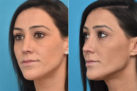 Injectable Fillers Photos Philadelphia Pa Patient 1326