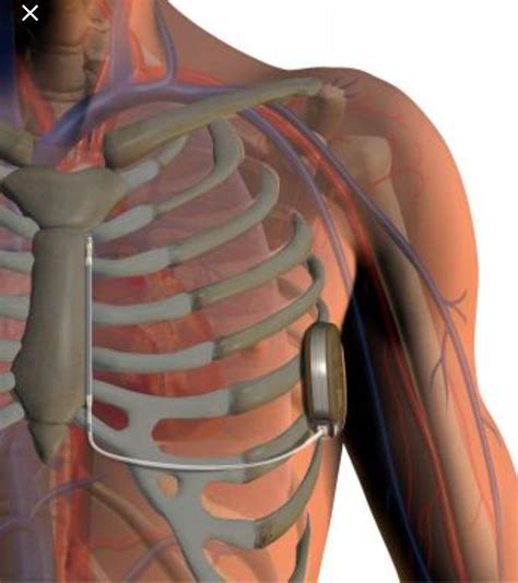Automatic Implantable Cardioverter Defibrillators Aicd Or Icd
