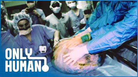 Doctors Remove Stomach Tumor Of The Size Of An Adult Person Amazing