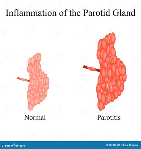 Inflamación Del Glándula Parótida La Estructura De La Glándula Salival