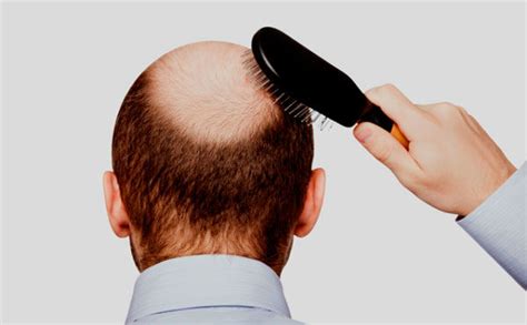 Hair Loss London Dermatology Clinic Skin Specialists
