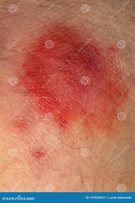 Shingles Disease Sympton Of The Herpes Virus On The Human Body Skin