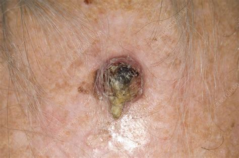 Squamous Cell Cancer